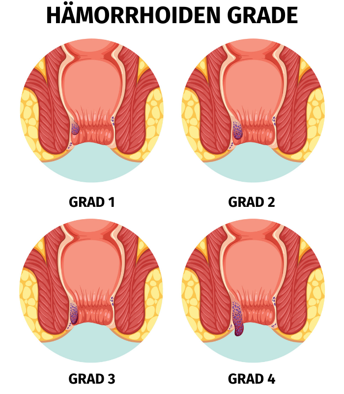 Grade von Hämorrhoiden, die Frau Kemper im MVZ behandelt.
