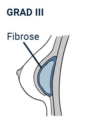 Kapselfibrose An Brust Implantaten Symptome Gefahren Kapselfibrose An Brust Implantaten Symptome Gefahren